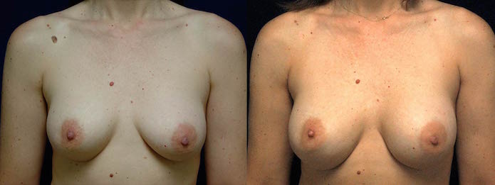 Ruptured Silicone Breast Implant Revision