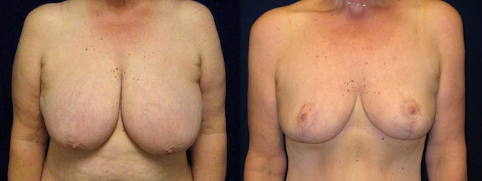 Breast Reduction with Breast Lift After Weight Loss