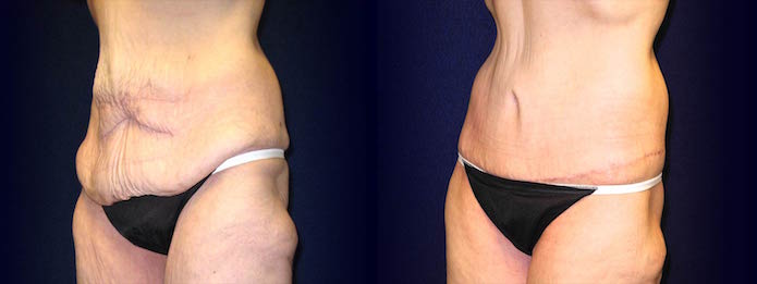 Cirumferential Tummy Tuck After Weight Loss