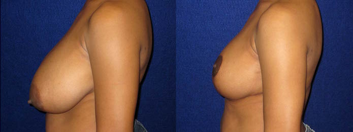 Breast Reduction - DDD-cup to C-cup