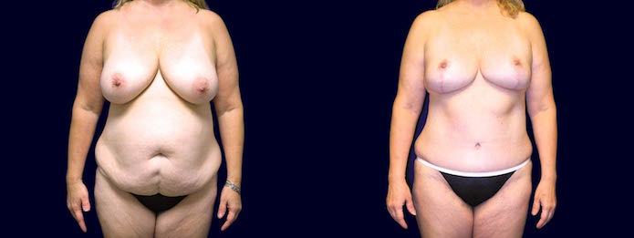 Breast Reduction Mastopexy and Tummy Tuck