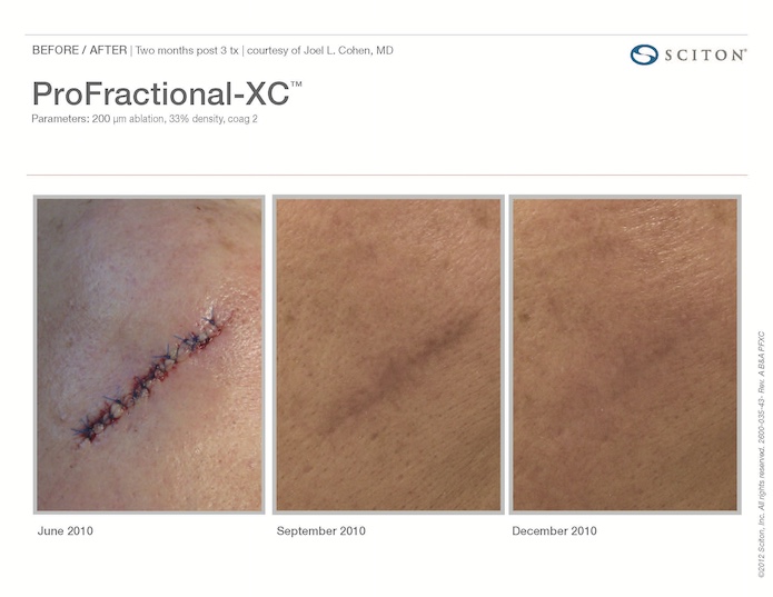 Profactional Laser Removal of Post-Surgical Scars