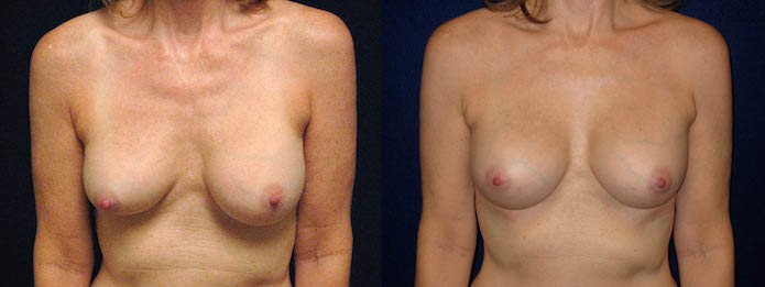 Deflated Saline Breast Implant Revision with Silicone Impant
