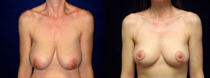 Breast Lift with Breast Reduction
