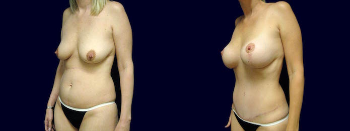 Mommy-plasty with Breast Augmentation, Breast Lift, Liposuction, and Tummy Tuck