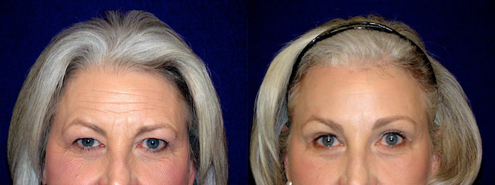 Upper Blepharoplasty with Browlift