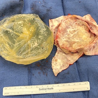 Ruptured silicone implant on the left and a total capsulectomy specimen on the right. The capsule has been opened and is white because it is calcified.