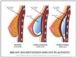 Breast implant placemtent options