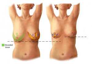 Fate of the nipple in a mastopexy