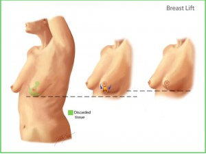 Oncologic breast reconstruction