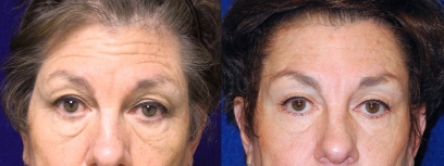 Frontal View - Browlift with Upper & Lower Eyelid Surgery