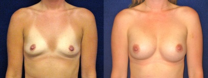 Frontal View - Breast Augmentation Frontal View - Breast Augmentation