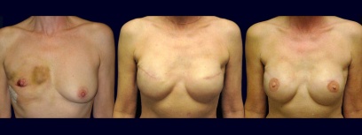 Frontal View - Breast Reconstruction Frontal View - Breast Reconstruction