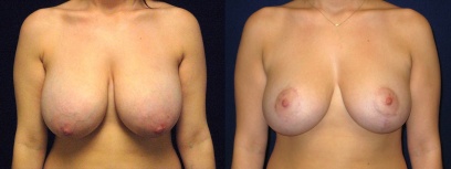 Frontal View - Breast Reduction Frontal View - Breast Reduction