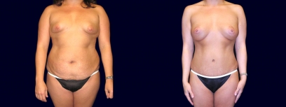 Frontal View - Breast Augmentation with Periareolar Lift & Tummy Tuck
