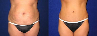 Frontal View - Tummy Tuck After Pregnancy