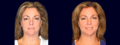 Full Fontal View - Upper Eyelid Surgery Full Fontal View - Upper Eyelid Surgery