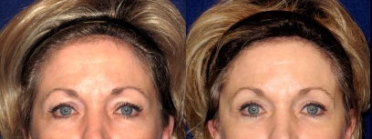 Fontal View - Upper Eyelid Surgery Fontal View - Upper Eyelid Surgery