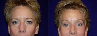 Frontal View - Browlift and Rhinoplasty