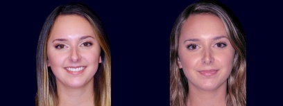 Frontal View - Rhinoplasty Frontal View - Rhinoplasty