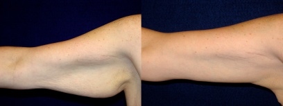 Frontal View - Right Arm - Arm Lift