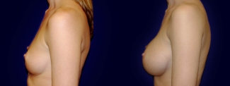 Left Profile View - Breast Augmentation - Saline Implants