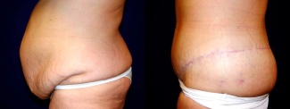 Left Profile View - Circumferential Tummy Tuck After Massive Weight Loss
