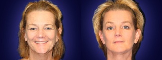 Full Fontal View - Upper Eyelid Surgery with Browlift