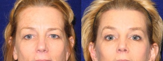 Fontal View - Upper Eyelid Surgery with Browlift