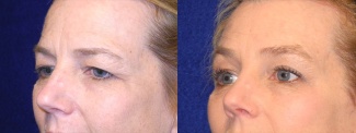 Left 3/4 View - Upper Eyelid Surgery with Browlift