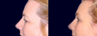 Left Profile View - Upper Eyelid Surgery with Browlift