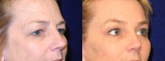 Right 3/4 View - Upper Eyelid Surgery with Browlift