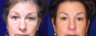 Frontal View - Browlift with Upper & Lower Eyelid Surgery