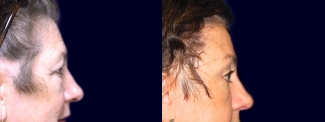 Right Profile View - Browlift with Upper & Lower Eyelid Surgery