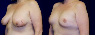 Left 3/4 View - Breast Reconstruction