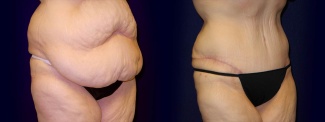 Right 3/4 View - Tummy Tuck After Weight Loss