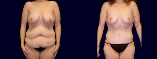 Frontal View - Surgery After Weight Loss - Breast Lift & Tummy Tuck