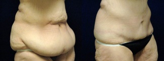 Right 3/4 View - Circumferential Tummy Tuck After Massive Weight Loss