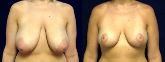Frontal View -  Breast Lift 