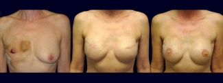 Frontal View - Breast Reconstruction