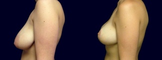 Left Profile View - Breast Lift