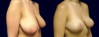 Right 3/4 View - Breast Lift