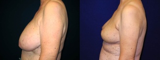 Right Profile View - Breast Reconstruction