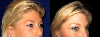 Right Profile View - Upper Eyelid Surgery