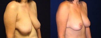 Right 3/4 View - Breast Lift After Pregnancy