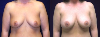 Frontatl View - Breast Augmentation After Weight Loss