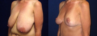 Left 3/4 View - Breast Lift Reduction