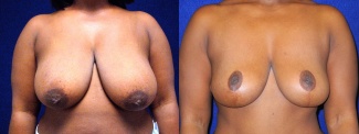 Frontal View - Breast Reduction Lift