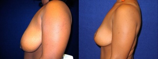 Left Profile View - Breast Reduction Lift