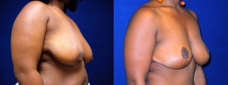 Right 3/4 View - Breast Reduction Lift